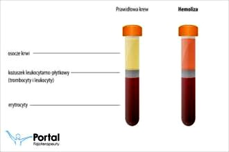Rozpad czerwonych krwinek – kiedy jest naturalny, a kiedy oznacza chorobę?