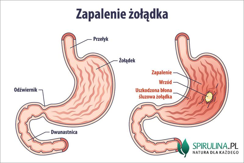 Bole brzuszne