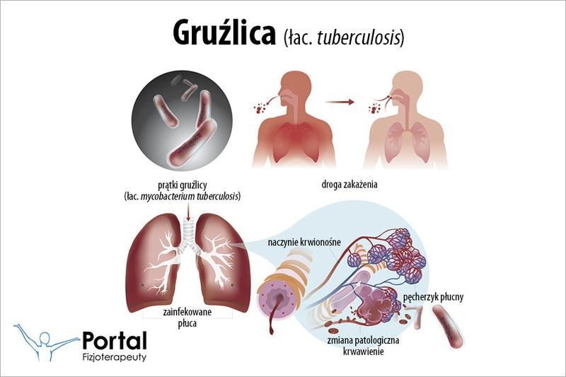 Diagnostyka gruźlicy