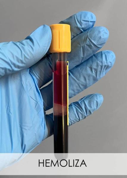 Diagnostyka hemolizy