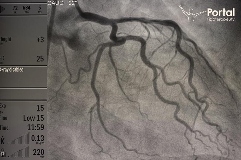 Koronarografia diagnostyczna