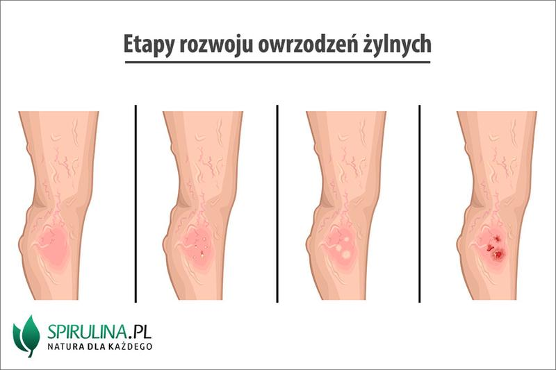 Szybka reakcja na owrzodzenie