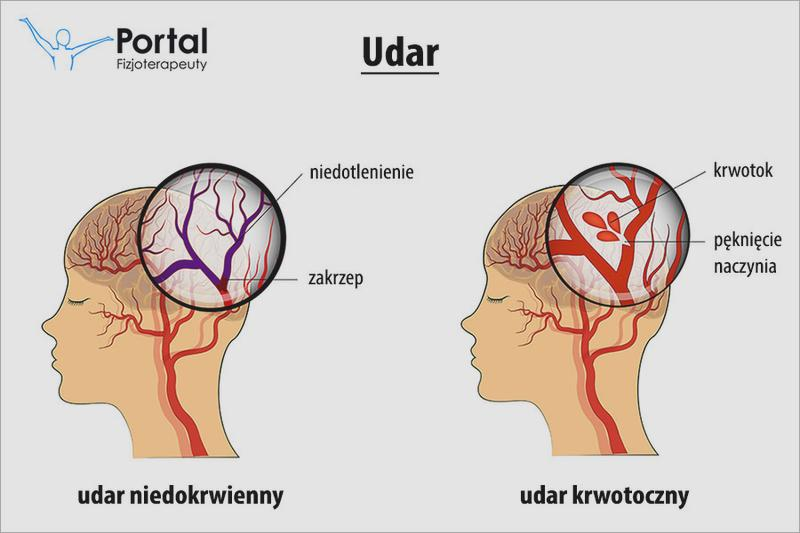 Udar krwotoczny